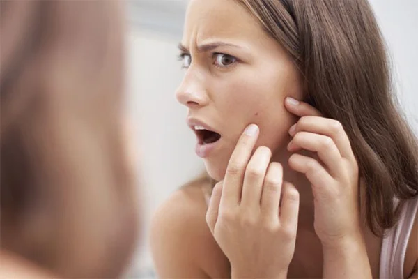 benzoyl peroxide trị mụn gì