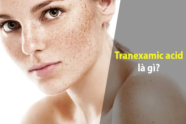 tranexamic-acid-la-gi