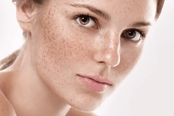 tăng sắc tố là gì