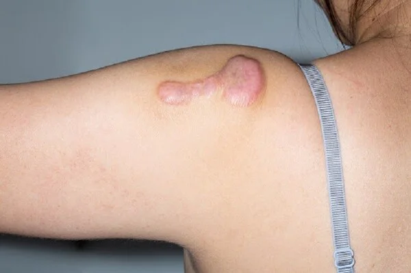 điều trị sẹo phì đại