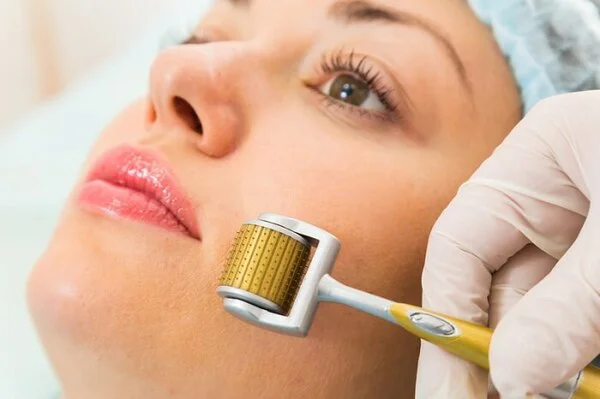 lăn kim trị sẹo