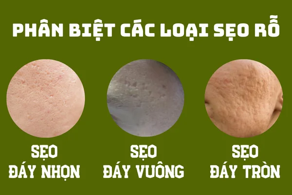 phân biệt các loại sẹo lõm