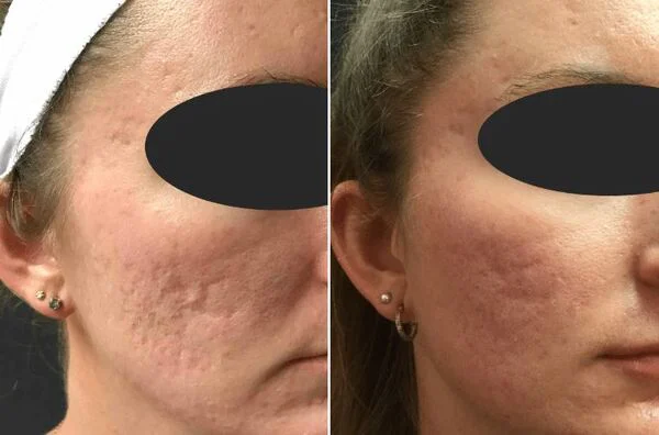 tiêm filler trị sẹo