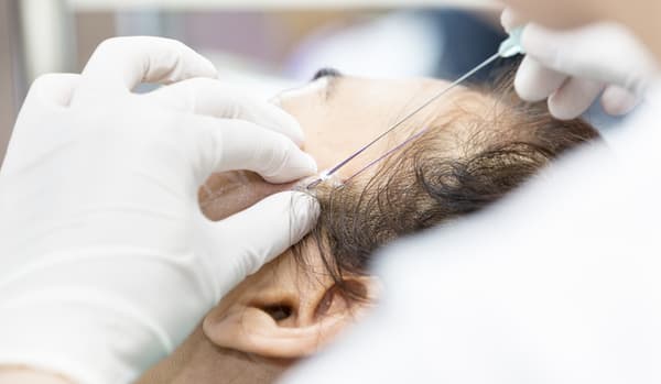 căng da mặt bằng chỉ