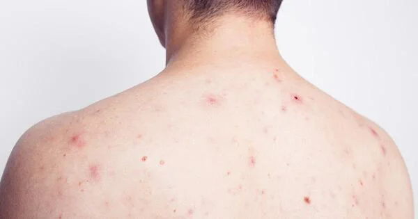 trị mụn lưng tại nhà