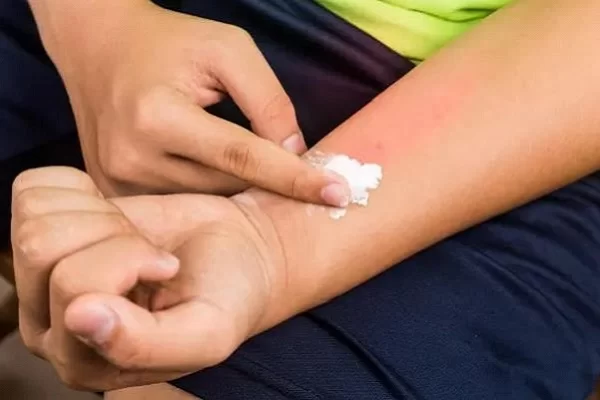 trị vết cắn của côn trùng